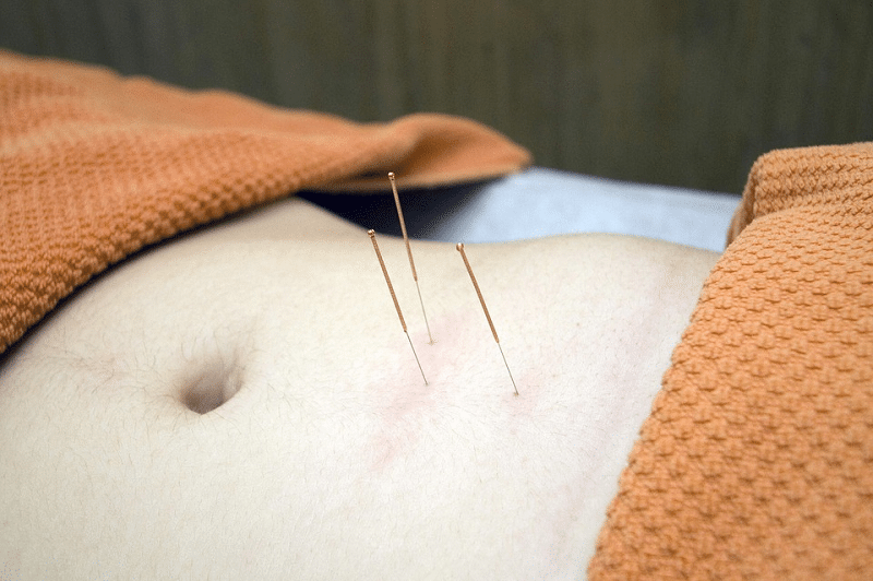 Akupunktura a akné